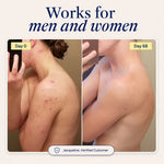 Natural Acne Supplement for Clear Skin
