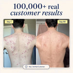 Natural Acne Supplement for Clear Skin